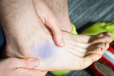 Decoding Contusions: Understanding Bruises, Causes, and Healing