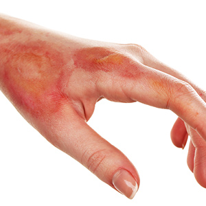 BurnsTreatment in Bolingbrook, Palatine, and East Dundee IL 