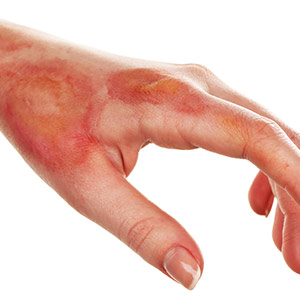 Burns Treatment in Bolingbrook, Palatine, and East Dundee IL