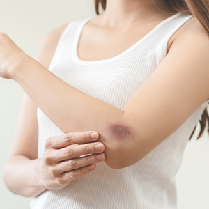 Contusions Treatment in Bolingbrook, Palatine, and East Dundee IL