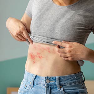 Minor Skin Infections Treatment in Bolingbrook, Palatine, and East Dundee IL
