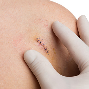 Suturing in Bolingbrook, Palatine, and East Dundee IL