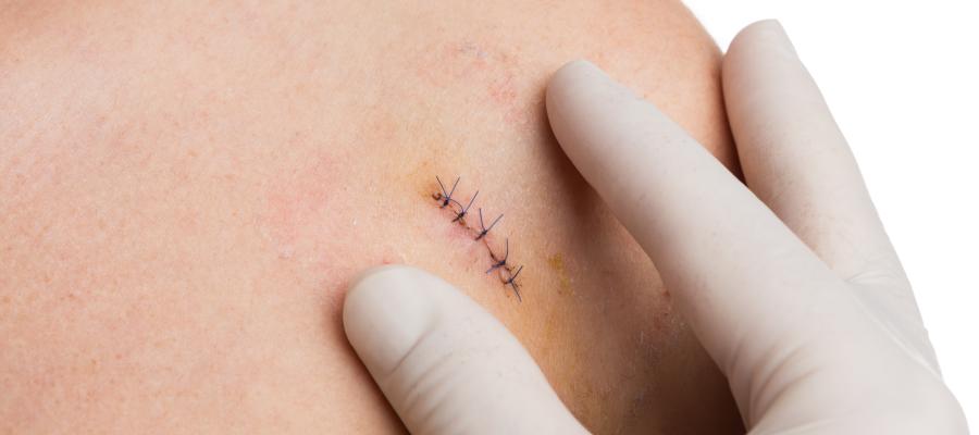 Where Can You Get Suture Removal Services in Palatine, IL? Where Can You Get Suture Removal Services in Palatine, IL?