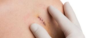 Where Can You Get Suture Removal Services in Palatine, IL? Where Can You Get Suture Removal Services in Palatine, IL?